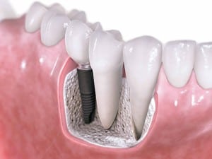 Dental Implants in Huntington Beach