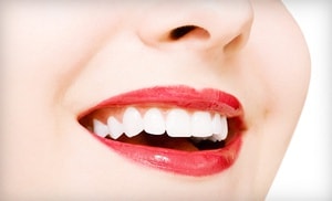 Porcelain Veneers in Huntington Beach